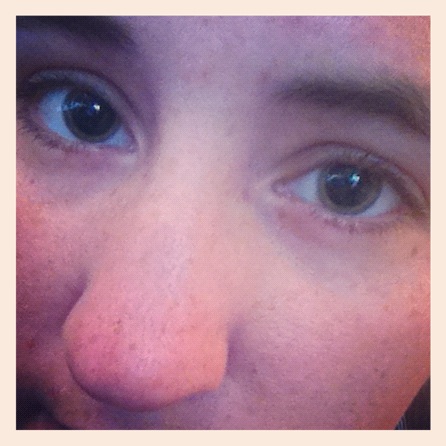LASIK dilation